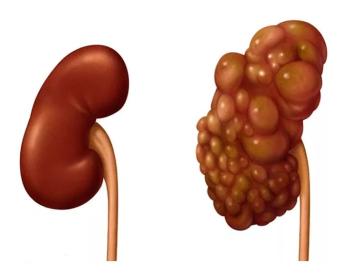 多囊肾最新治疗方法，突破限制，带来希望之光